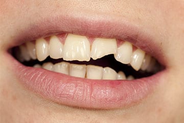 Teeth-Grinding-Problem-Dental-Treatment-Paisley-Street-Footscray